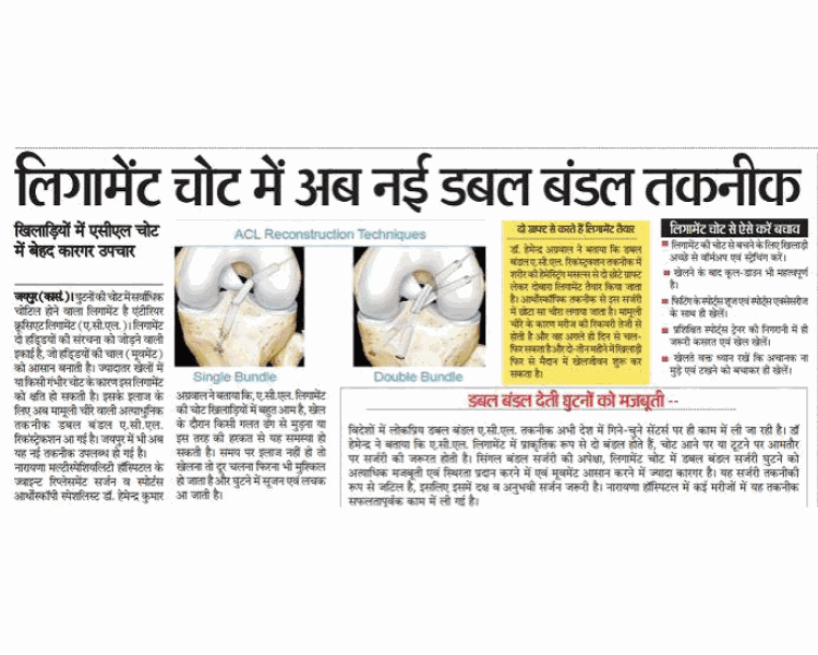 Double-bundle ACL reconstruction technique for sportspersons' ligament injuries